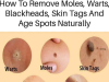 Natural Remedies for Treating Age Spots, Moles, Skin Tags, Warts, and Blackheads