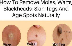 Natural Remedies for Treating Age Spots, Moles, Skin Tags, Warts, and Blackheads