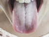 Understanding the Causes of a White Tongue: What Your Tongue May Be Telling You