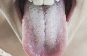 Understanding the Causes of a White Tongue: What Your Tongue May Be Telling You