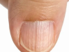 Doctor Explains What It Means If You Have Ridges on Your Fingernails