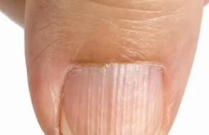 Doctor Explains What It Means If You Have Ridges on Your Fingernails