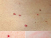 Red Dots on Your Skin: Causes and What They Could Mean