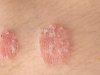 If You Notice These Signs on Your Body, Consult a Doctor Immediately: Understanding Psoriasis