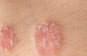 If You Notice These Signs on Your Body, Consult a Doctor Immediately: Understanding Psoriasis