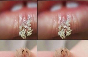 Getting Rid of Warts Naturally: Effective Home Remedies