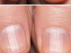 Striped Nails: What They Could Reveal About Your Health