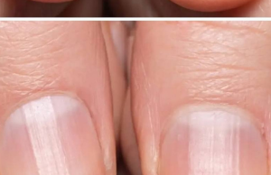 Striped Nails: What They Could Reveal About Your Health