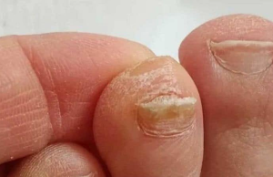 Managing Thick Toenails: A Simple and Effective Home Remedy Passed Down Through Generations