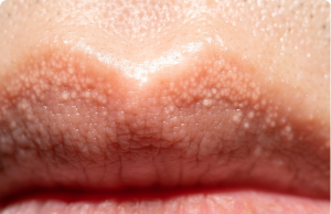 What Are Those White Bumps That Can Appear on Your Private Parts—and What Causes Them?