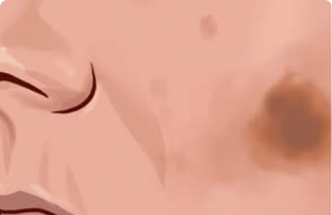 Here’s a 2-Ingredient Hack for Getting Rid of Brown Spots on Your Skin