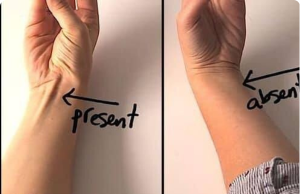 If a Tendon Raises Up When You Touch Your Pinky to Your Thumb, Here’s What It Could Mean