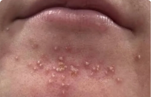 Be Careful! These Are the Consequences of Sleeping with Makeup On — Especially If You’re Breaking Out on Your Chin