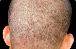 We Tried Switching Shampoos, But This Keeps Flaring Up on My Son’s Scalp — What Else Helps with Scalp Breakouts?