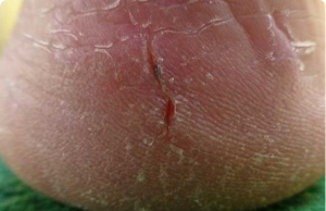My Heels Are Splitting Open — No Lotion Helps. What Else Can I Do? Should I See a Doctor?
