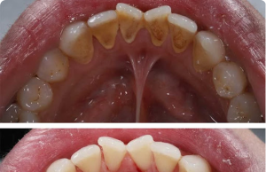 7 Top Hacks to Get Rid of Unsightly Tartar Stains With Almost Zero Effort