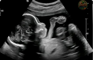 Off the Record: Groundbreaking Study Links Gut Health to Autism Risk — Starting in the Womb