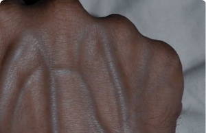 5 Health Conditions That Can Cause Visible Veins — And When to Worry