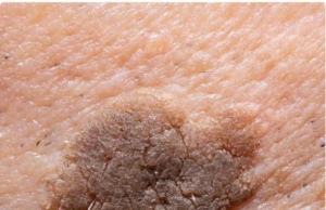 This Mole-Like Spot Is Growing But Doesn’t Hurt — Doctor Appointment Is Weeks Away. What Should I Do?