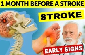 Silent Alarms: 8 Early Stroke Warning Signs Your Body Might Send Weeks in Advance