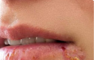If You See This Appearing on Your Lips, It’s a Sign of Cold Sores — Here’s What You Need to Know