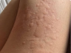 Her Whole Body Was Itchy: What She Thought Was a Common Allergy Was Hiding Something More Serious