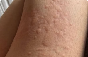 Her Whole Body Was Itchy: What She Thought Was a Common Allergy Was Hiding Something More Serious