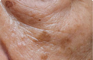 Age Spots and Selenium: How This Powerful Mineral Can Help Fight Sun Damage Naturally