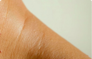 Why Do I Get Flesh-Colored Moles on My Neck or Armpits — and How Do I Get Rid of Them? Experts Explain