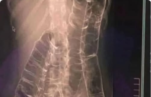 Everything You Need to Know About Chronic Constipation: A Hidden Threat to Your Digestive Health