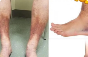 Do You Know What These Signs on Your Feet Mean? The Hidden Warning of Poor Circulation