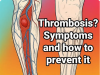 Thrombosis: What It Is, How to Identify Its Symptoms, and Prevent It Naturally