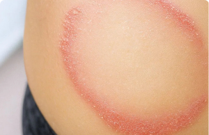 How to Identify and Cure Skin Fungus or Ringworm — The Complete Guide