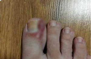 How to Treat an Ingrown Toenail at Home: Effective Tips & Natural Remedies