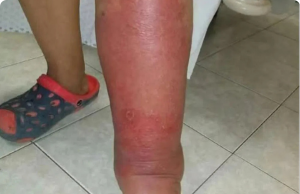 Signs on Your Feet: Could Your Toes Be Trying to Warn You About Your Health?