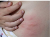 Ugh, These Are So Annoying: Understanding Swollen, Red, Itchy Skin Spots