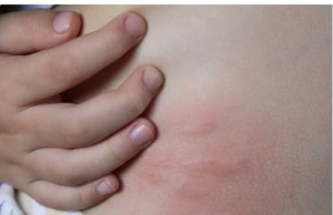 Ugh, These Are So Annoying: Understanding Swollen, Red, Itchy Skin Spots