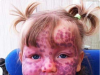 Parents Respond to Strangers Who Jump to Hurtful Conclusions About Their Daughter’s Rare Skin Condition
