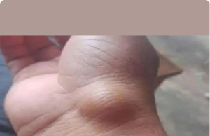 BE CAREFUL: If You Get These Bruises on Your Body, It Might Mean Something Serious