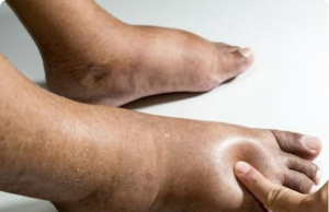 Swollen Hands & Feet? Eat These 7 Science-Backed Foods to Drain the Bloat (No Diuretic Pills Needed)