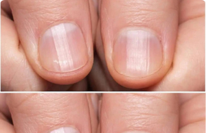 Striped Nails: The Truth Behind the Viral “Health Warning” Hoax (What Dermatologists Actually Want You to Know)
