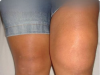 Why Is One Knee Swollen But Not the Other? A Doctor’s Guide to Sudden, Unilateral Knee Swelling