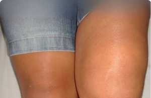 Why Is One Knee Swollen But Not the Other? A Doctor’s Guide to Sudden, Unilateral Knee Swelling