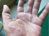 Hand Dermatitis: The Viral “Natural Cures” That Are Actually Burning Your Skin Off (And What Really Works)
