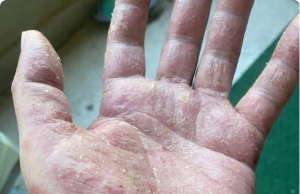 Hand Dermatitis: The Viral “Natural Cures” That Are Actually Burning Your Skin Off (And What Really Works)