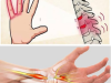 Numb Hand: The Viral “Pinched Nerve” Myth That’s Actually Causing Permanent Nerve Damage (And What Really Causes That Tingling)
