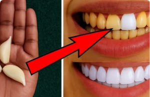 Garlic for Teeth Whitening: The Viral “Natural Hack”