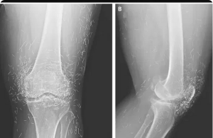 X-Ray Reveals Hundreds of Gold Needles in Woman’s Knees