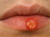 Crusty sore on my lip won’t go away. Appointment is impossible to get right now. What is this?