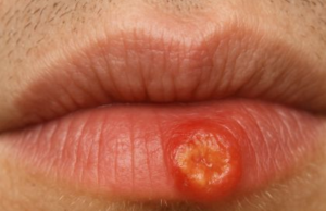 Crusty sore on my lip won’t go away. Appointment is impossible to get right now. What is this?